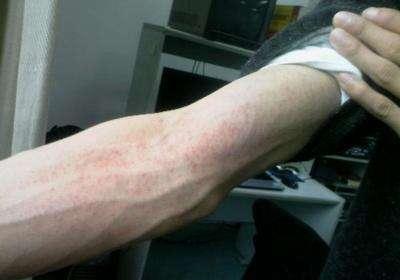 非布司他降尿酸快还是苯溴马隆,非布司他降尿酸痛风发作继续吃么