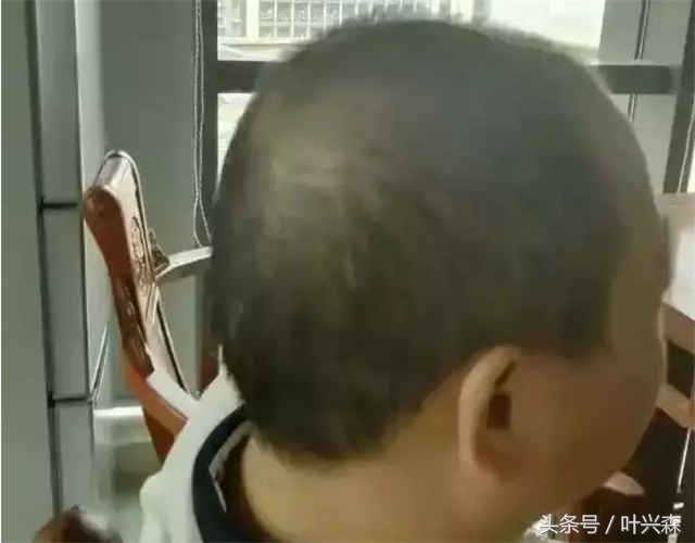 脱发掉发秃顶你该了解生发方法了,秃顶脱发最好的治疗方法