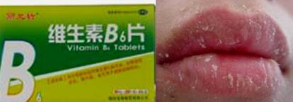 维生素缺乏神经性皮炎,治疗口腔溃疡脚气病的维生素