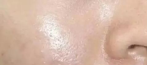夏季爱出油毛孔大,夏季男生油脂分泌旺盛毛孔堵塞