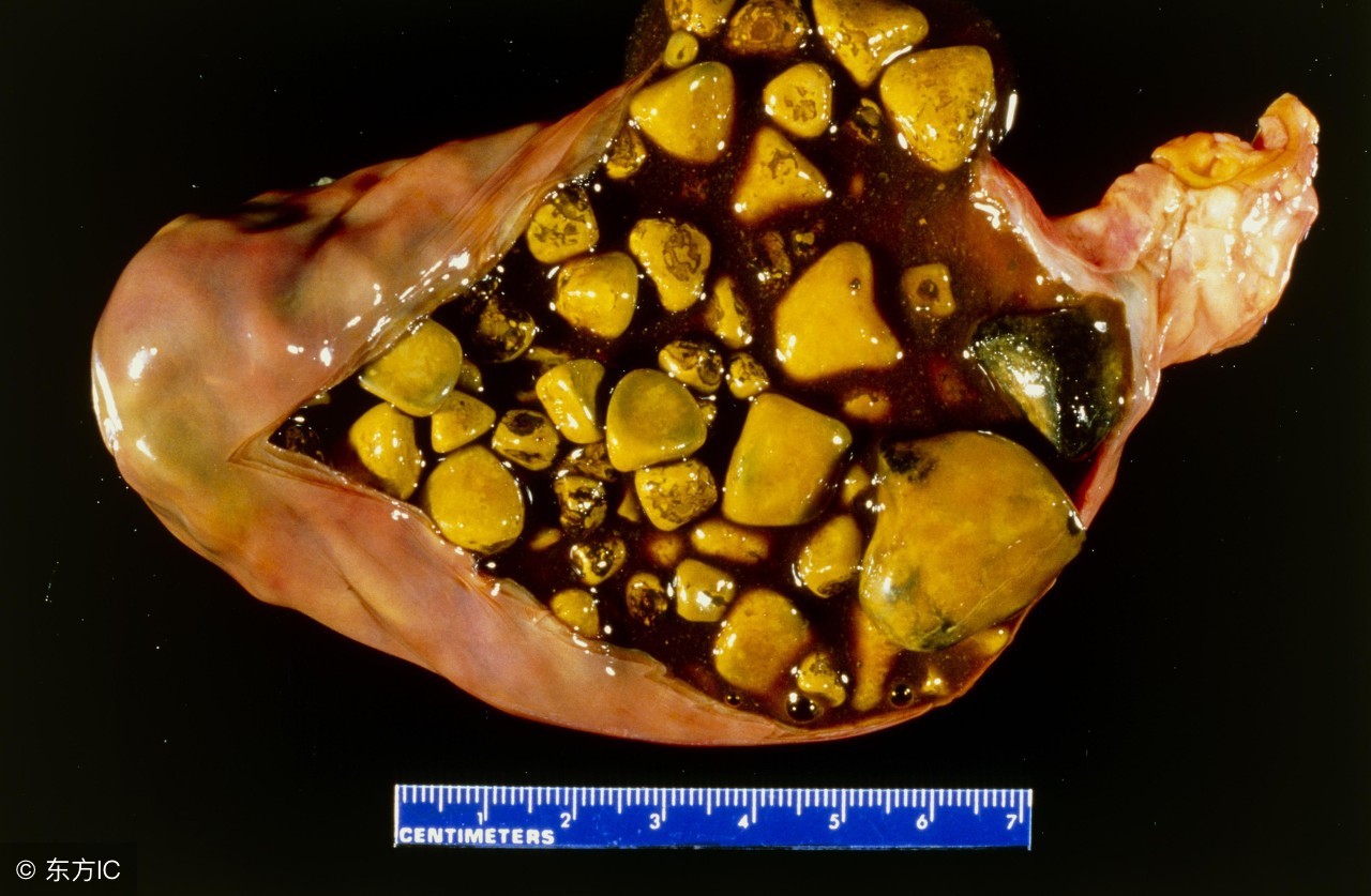 胆结石的症状有哪些,胆结石不能吃什么食物