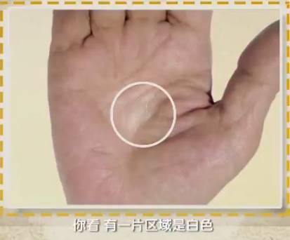 手健康有多重要,手型看健康