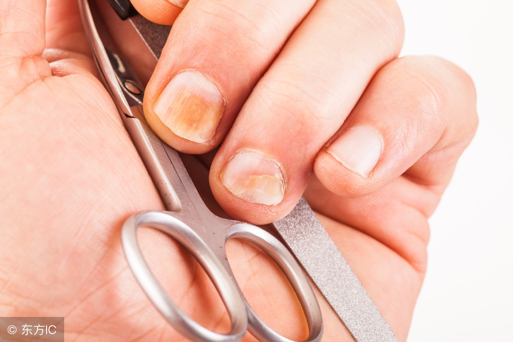 预防和治疗灰指甲有什么特效药,灰指甲怎么形成的怎样预防治疗
