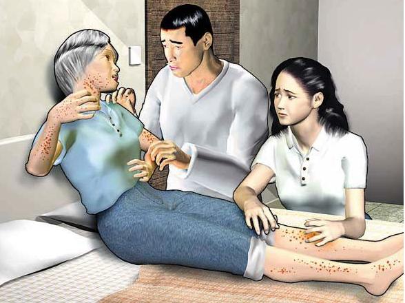 免疫性血小板减少症用激素副作用,血液病血小板减少症怎么治疗