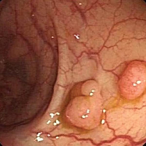 体检发现肠息肉病例,年轻女性查出肠息肉