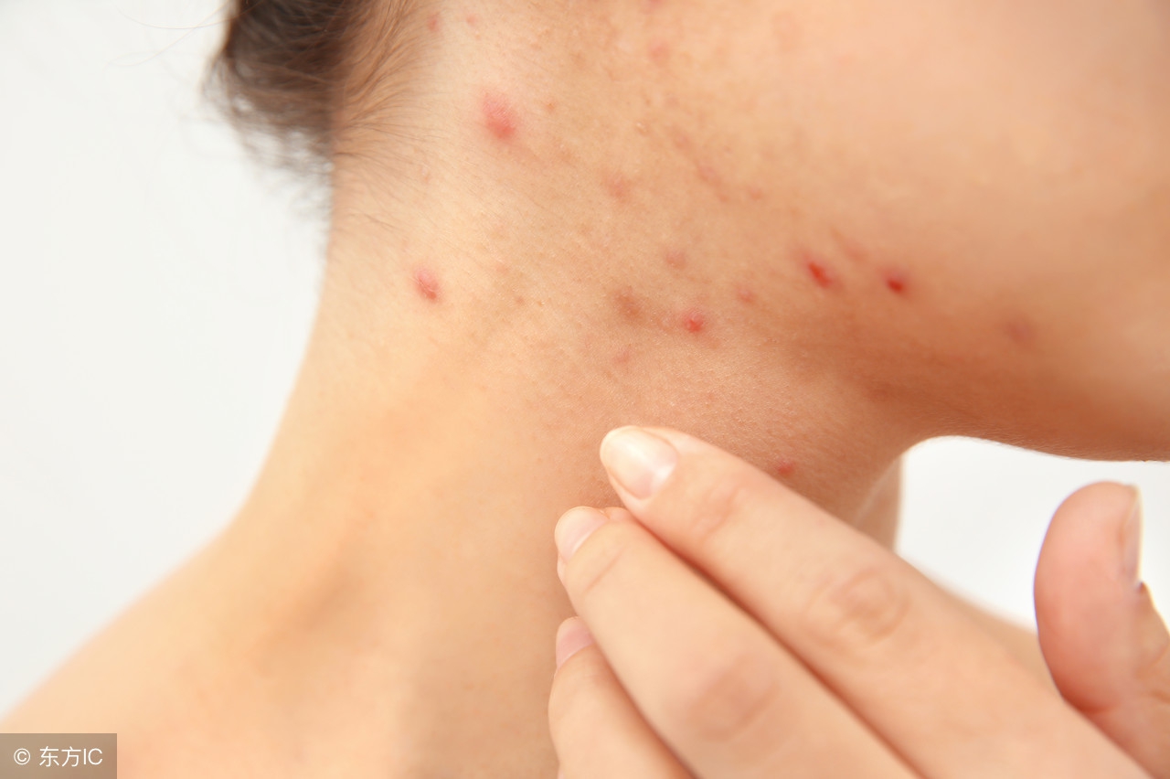 每次睡醒后身上起疙瘩,睡觉起床后身上长很痒的红疙瘩