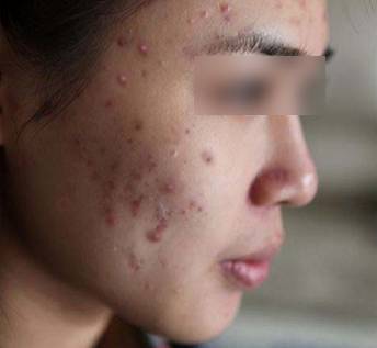 皮肤差真正能改善的面膜,哪几种面膜用了会烂脸