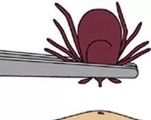 驱蚊止痒一招搞定,用什么驱蚊止痒效果最好