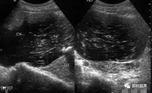 卵巢畸胎瘤的超声声像诊断,超声能不能看到卵巢畸胎瘤内部