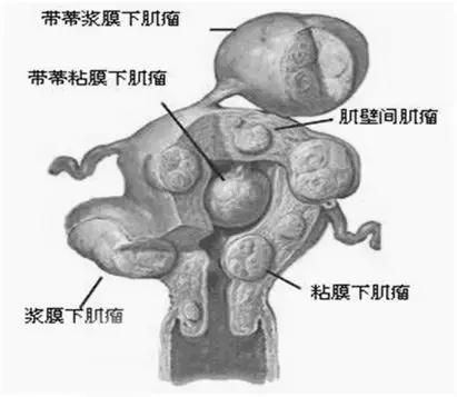 「解惑」它影响怀孕吗?听听妇产科专家怎么说