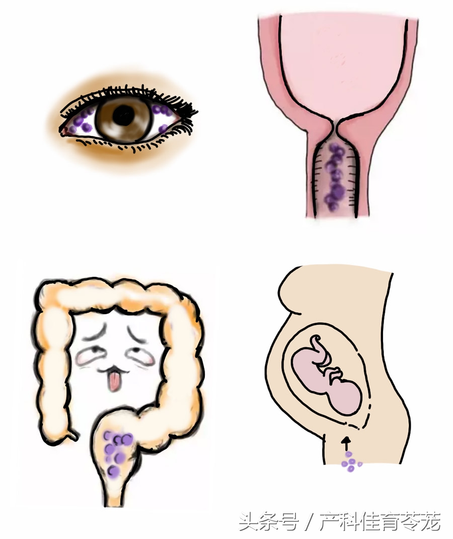 沙眼衣原体阳性是什么原因导致的,发病率最高的性传播疾病