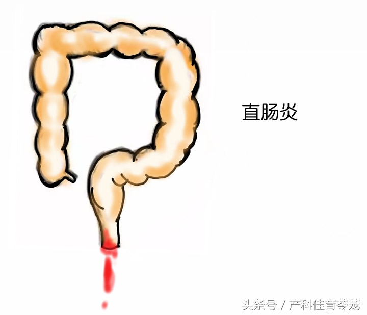 沙眼衣原体阳性是什么原因导致的,发病率最高的性传播疾病