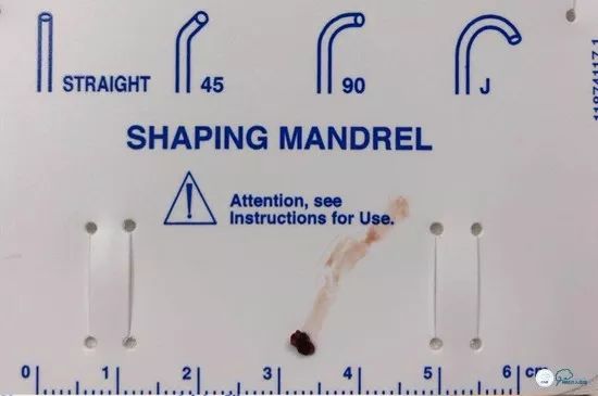 基底动脉闭合手术,基底动脉闭塞取栓一直昏睡