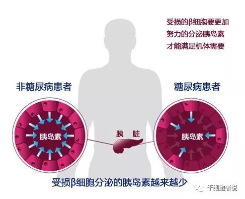 干细胞治疗一型糖尿病新进展,fda干细胞治疗一型糖尿病