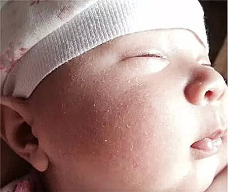 宝宝营养过剩的表现和危害,哪种元素缺乏会影响胎儿脑发育