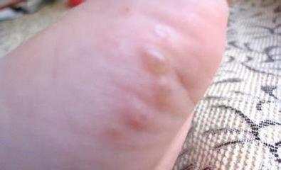 治疗脚气的最便捷方法,除脚气的绝招