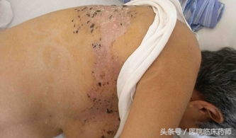 带状疱疹一穿衣服就疼,痛到不能穿衣的带状疱疹怎么治