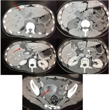 不可思议，22岁的小年轻，转呼啦圈转到脾破裂！