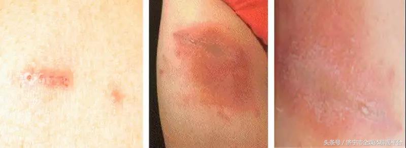 隐翅虫咬人后会有什么症状,隐翅虫咬人后有什么症状