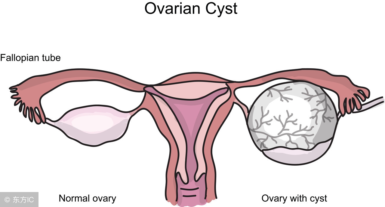 囊肿与肿瘤有啥区别?到底应该如何区分囊肿和肿瘤?