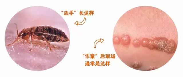 宝宝被蚊虫叮咬最好的解决办法,宝宝被蚊虫叮咬后有什么好办法吗