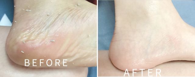 擦掉一块皮用什么药,擦掉了一小块皮一般需要多久恢复