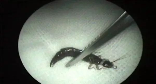 常德女子突然头晕头痛还耳鸣，竟然是这种生物在耳内“安家”了！