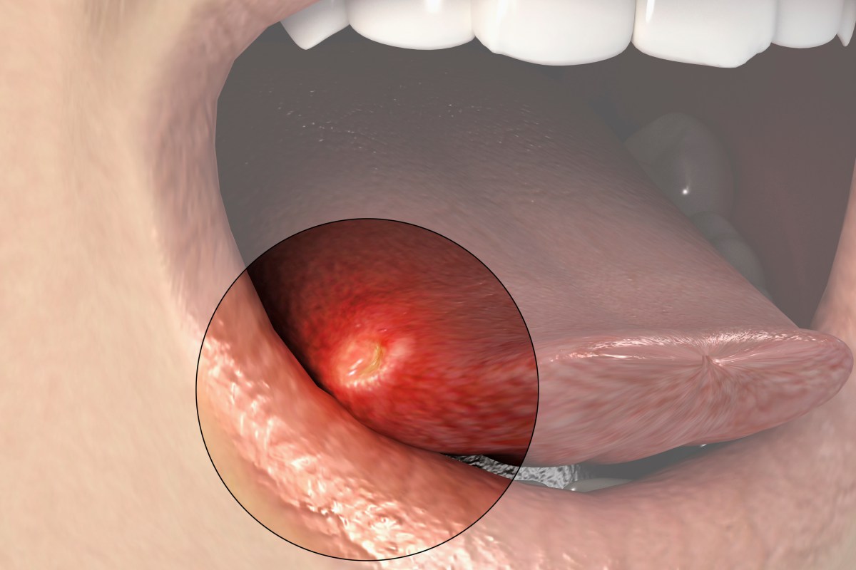 口腔、眼睑、阴道反复溃疡，你可能患上了白塞氏病
