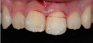 怎么拯救牙齿最快最有效,如何拯救牙齿