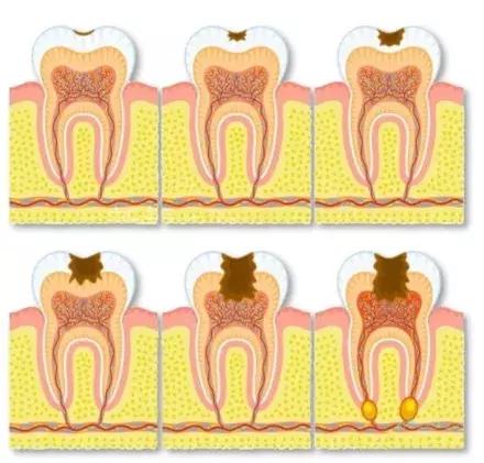 乳牙蛀了不疼,乳牙蛀了不用管