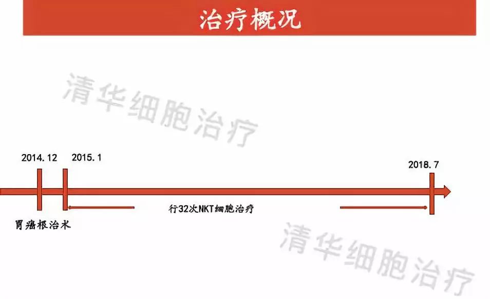 胃癌nk治疗多少钱,胃癌ncaa指南