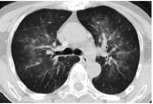 蝶翼征是间质性肺水肿的表现吗,肺蝶翼征