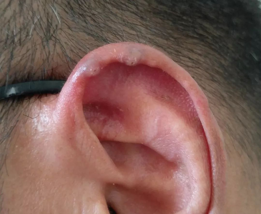 「关注」耳朵边上的小豆子