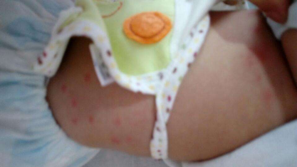 宝宝的脸上起了小红点是怎么回事,宝宝屁股上起了点小红点点