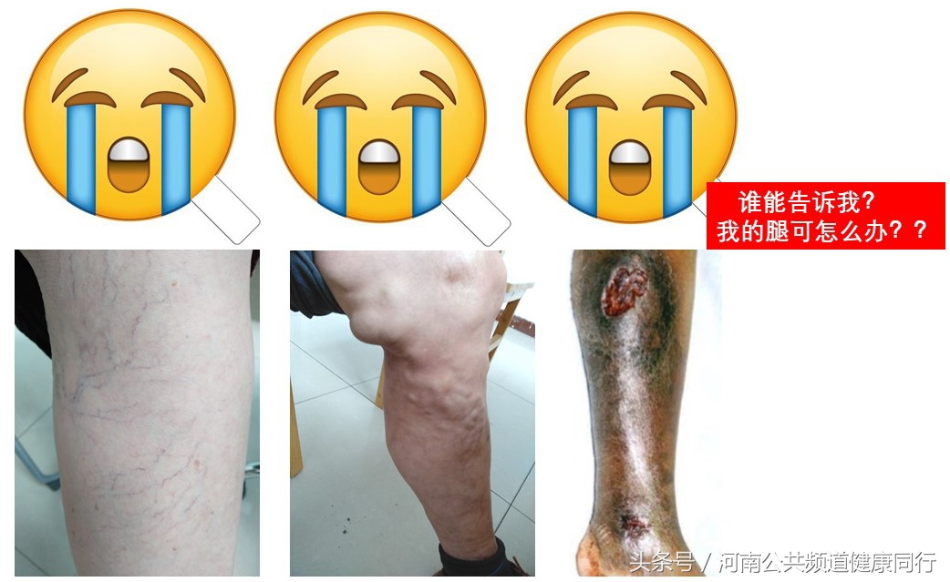 静脉曲张郑大一附院看哪个科,郑大一附院硬化剂治疗静脉曲张