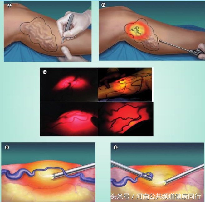 静脉曲张郑大一附院看哪个科,郑大一附院硬化剂治疗静脉曲张