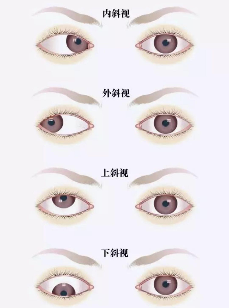 婴幼儿斗鸡眼症状,孕期怎么预防胎儿斗鸡眼