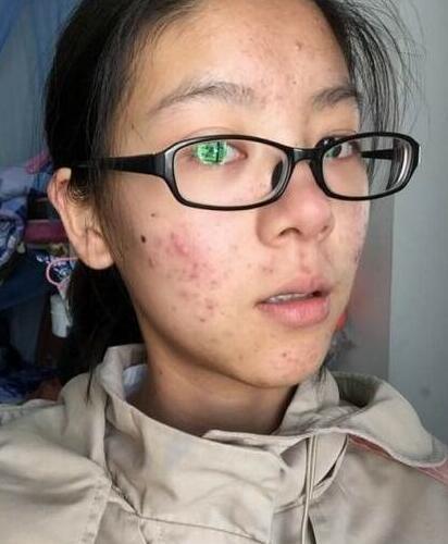 挤完痘痘要怎么治疗,痘痘同一个位置老复发是什么原因