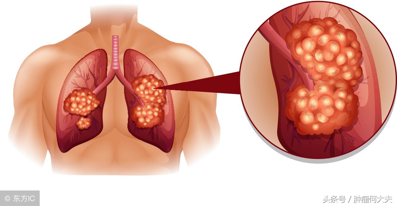 计春华肺癌属于什么类型,计春华肺癌原因