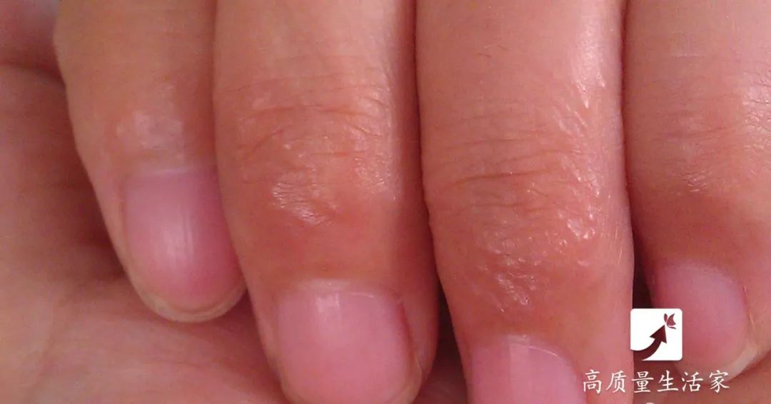 手上长水泡非常痒别抓这样处理,手上起小水泡看哪个科