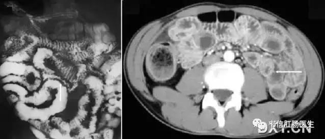 10种经典肠道影像征象详解