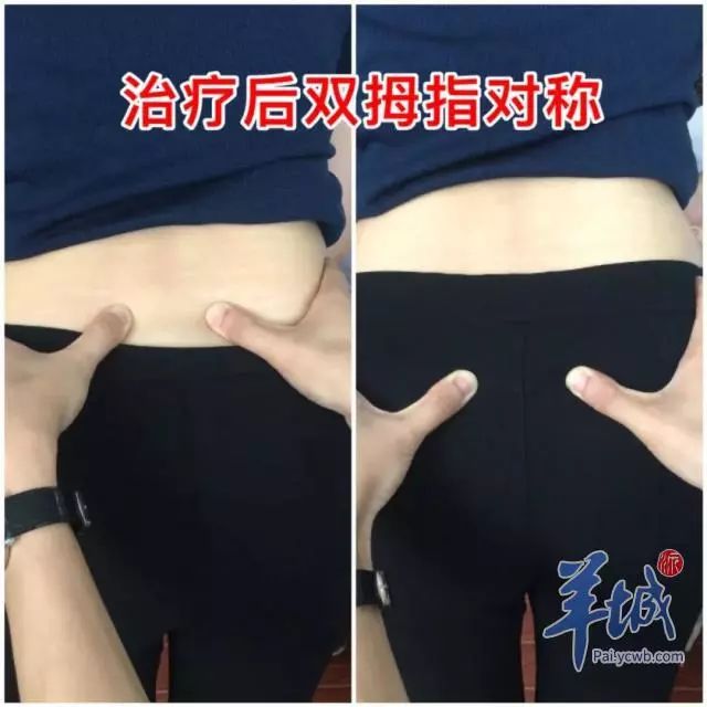 腰疼骶骨错位怎么治,骶骨痛和腰痛是怎么回事