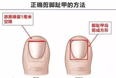 脚趾甲好痛怎么办,脚趾甲嵌入肉里垫棉花有效吗
