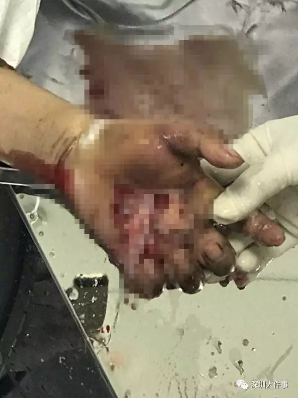 广东英德蛇咬伤人事件,广州英德最近被蛇咬事件