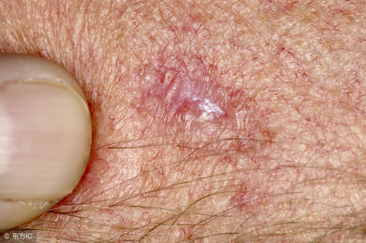 皮肤溃烂反复无法愈合癌症,皮肤溃烂伤口不愈合挂什么科