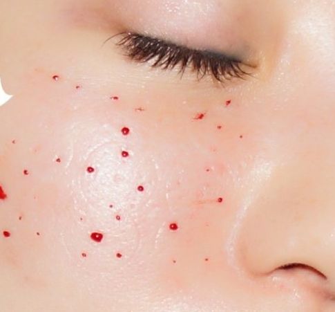 水光针和涂抹式水光针区别在哪里,涂抹式水光针是骗人的吗