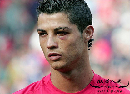 c罗的眼角被撞血流如注,眼角被撞一道口子