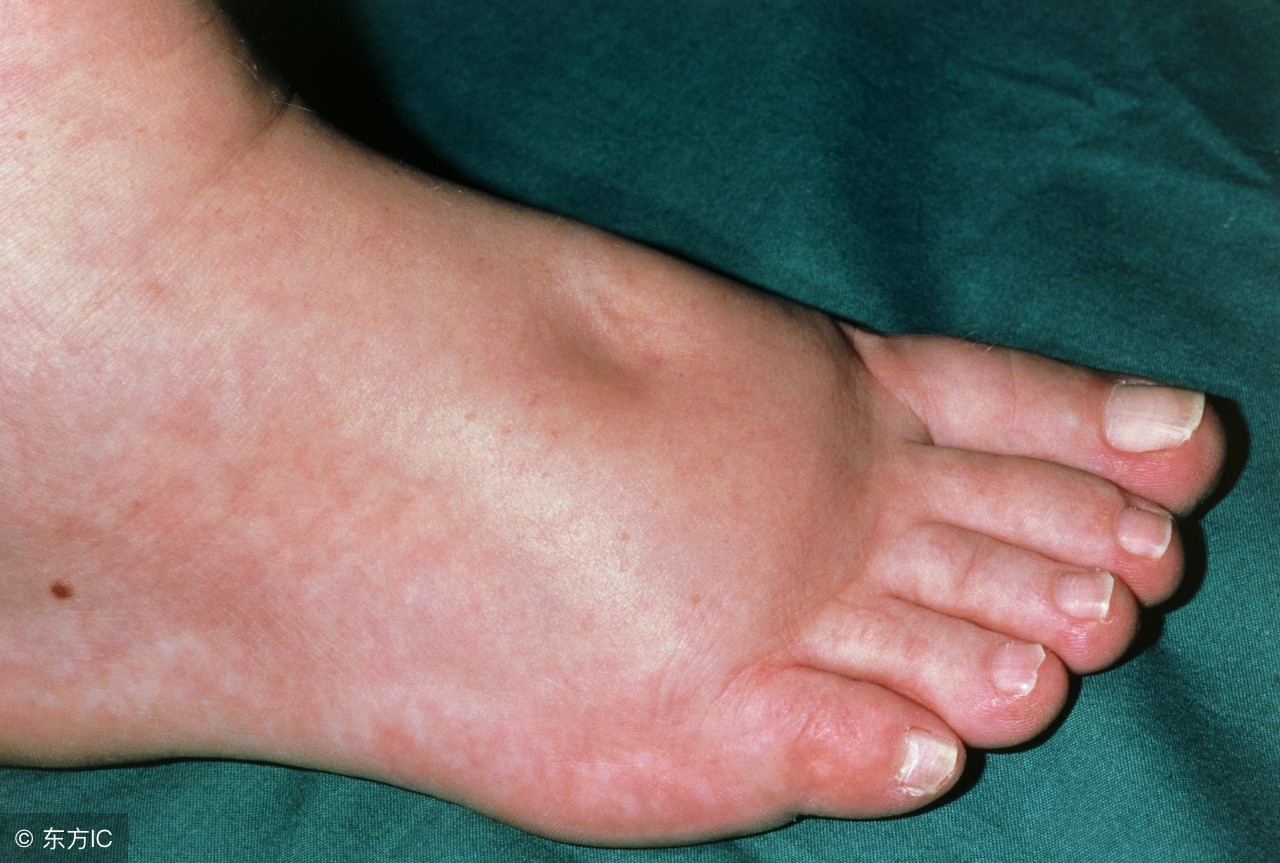 孕期水肿怎么办快来get解决方案,孕期水肿不可怕6招教你轻松缓解