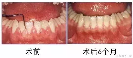 新生儿牙龈上的白脓包,牙龈炎症脓包疼痛怎么办