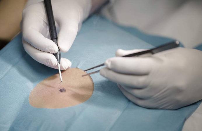 痣发红寓意,痣发红发痒怎么回事